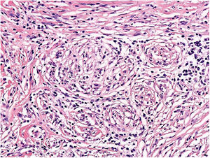 Neural transformation of a melanoma, also known as neurotropism. Hematoxylin-eosin, original magnification ×200.