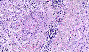 Melanoma cells in perivascular space (angiotropism). Hematoxylin-eosin, original magnification ×400.