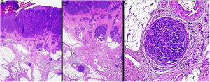 Presence of microscopic metastases (microsatellitosis) deep to a primary melanoma. Hematoxylin-eosin, original magnification ×40 (A), ×100 (B), ×200 (C).