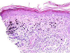 Replacement of tumor cells by lymphocytic inflammation, attentuation of epidermis, melanophagocytosis, and numerous telangiectatic vessels in the regression area of a melanoma. Hematoxylin-eosin, original magnification ×100.