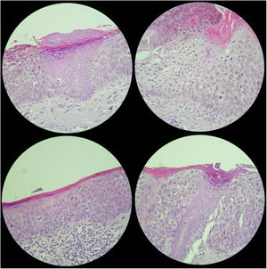 Histology images of the lesion.