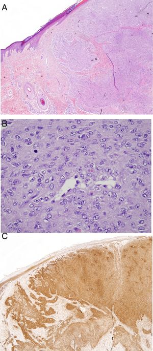 A, Hematoxylin–eosin, ×10. B, Hematoxylin–eosin, ×40. C, Smooth-muscle actin (SMA) ×10.