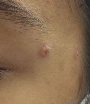 Molluscum-like lesion on the face.