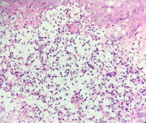 Biopsy of molluscum-like lesion on the face showing vacuolated spaces, neutrophils, and yeast-like structures that appear to have a capsule, as is seen in gelatinous cryptococcosis (hematoxylin–eosin, ×400).