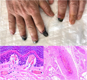 Thrombosis due to coronavirus disease 2019. Upper photograph: The shape of the distal portion of several fingers has become sharper and the tips have taken on a blackish color. Proximal to these ischemic areas, a brownish-gray macula has a residual retiform appearance. Detail of arterial thrombosis (right microphotograph). Hyaline thrombi inside dilated vessels in the papillary dermis (left microphotograph).