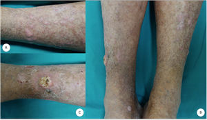 A, Polygonal hypertrophic erythematous-violaceous papules and plaques. A and B, Cutaneous xerosis and signs of chronic venous insufficiency. B and C, Tumor with a crateriform appearance a hyperkeratotic central area on the right pretibial region.