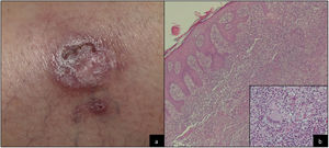 A, Clinical image. B, Histological image.