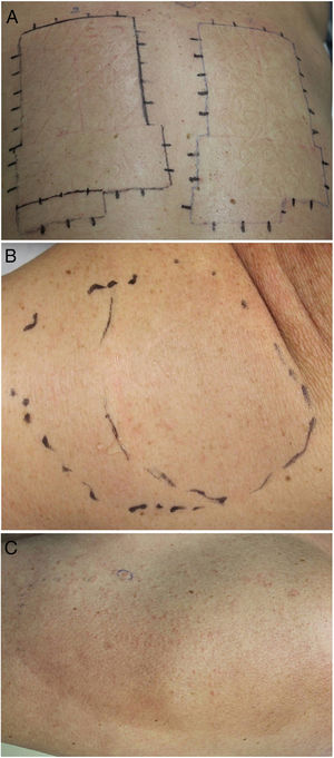 Photobiological study of the patient. A, Photopatch reading at 48 hours. The photopatches on the left were irradiated with UVA for 6 minutes using a Philips® HB 404 high pressure lamp (13.32 J/cm2). The patches on the right were not irradiated. No contact or photo-contact reactions were observed for the standard battery or for the drugs that the patient had been prescribed. Results were also negative after 96 hours. B, Photoprovocation on day 1 of irradiation (7 min; 15.54 J/cm2). The photoprovoked region consisted of an area directly irradiated with UVA (left) and an area covered with a water-filled Petri dish (right) to eliminate the infrared (IR) component. C, Photoprovocation at 144 hours. Isolated minute micropapules are evident on the left side of the irradiated area. Some of the lesions near the edge are larger. Milder lesions are also evident in the area protected from IR radiation.