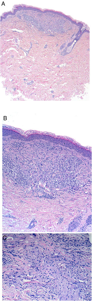 Histology of newly formed papules after photoprovocation. A, Well-circumscribed interstitial dermal infiltrate. At low magnification, neither granulomas nor epidermal involvement are observed (hematoxylin-eosin [HE] ×2, original magnification ×20). A higher magnification image reveals lymphohistiocytic infiltrate containing an important component of large cytoplasmic cells surrounding collagen bundles to create an interstitial granulomatous dermatitis pattern (HE ×10, original magnification ×100). C, High magnification image in which elastophagocytosis is not observed, ruling out a diagnosis of actinic granuloma (HE ×20, original magnification ×200).