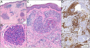 Tumoral thrombi, with dilated vessels throughout the dermis and the vascular lumen completely occupied by pleomorphic cells (mixed epithelioid and red cells). CD31 immunostaining demonstrates the nature of the tumoral proliferation inside the vessel. A, Hematoxylin-eosin (H&E), magnification × 20. B, H&E, magnification × 400. C, H&E, magnification × 200. D, CD31, magnification × 100.