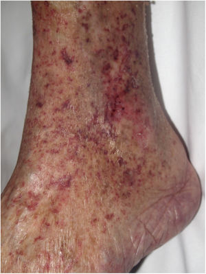 Lower extremity purpura after embolism caused by material coating a device used during an endovascular valve replacement procedure.