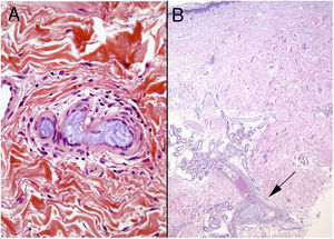 A, Histologic specimen revealing hydrophilic material from the coating of an endovascular device. The distribution is laminar. B, Another specimen contains hyaluronic acid material. Here the distribution is not laminar, the only feature that distinguishes it from the previous specimen.