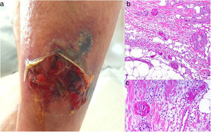 Calciphylaxis. A, An ulcerated, necrotic plaque on the leg. Note the violaceous border. Thrombosed vessels in the media of the dermis. Hematoxylin-eosin (H&E), magnification × 100. C, Detail of the thrombosed vessels. H&E, × 200.
