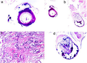 Calciphylaxis. A–B, Calcification of the media of medium-caliber vessels. Hematoxylin-eosin (H&E), magnifications × 100 and × 200, respectively. C, Calcification and interstitial necrosis. H&E, magnification × 400. D, Intimal proliferation accompanied by calcification of the vessel wall. H&E, magnification × 200.