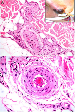 Catastrophic antiphospholipid syndrome. Note the skin necrosis on the nasal tip (inset, upper right corner). A, Venous thrombosis. Hematoxylin-eosin, × 100. B, Arterial thrombosis. Hematoxylin-eosin, magnification × 200.