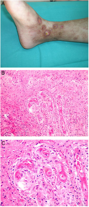 Livedoid vasculopathy. A, Erythema, multiple ulcers, and discoloration of the skin due to red cell extravasation on the leg of a 62-year-old woman with lupus erythematosus and venous insufficiency. B, Glomerular-like vascular aggregates in the superficial dermis. Hematoxylin-eosin, magnification × 100. C, Detail of the previous microphotograph. Note the vascular wall thickening, elevated number of pericytes, and homogeneous deposits of eosinophilic fibrinoid material. Around the blood vessel, note extravasated red cells, occasional hemosiderin-laden macrophages, a lymphomacrophagic infiltrate, and collagen fibrosis; Hematoxylin-eosin, magnification × 200.