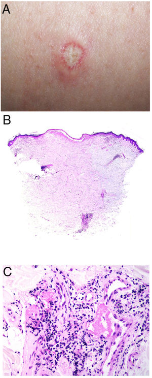 Degos disease. A, Atrophic papule with a porcelain-white center and a telangiectatic, erythematous halo. This lesion is considered a pathognomonic finding in this disease. B, Wedge-shaped infarct with a vertex extending downward. At the point of the vertex, a slight, chronic, perivascular lymphocytic infiltrate can be seen around the vessel. Hematoxylin-eosin, magnification × 20. C, Detail of the vessel shown above. Note the numerous intravascular thrombi. Hematoxylin-eosin, magnification × 400.
