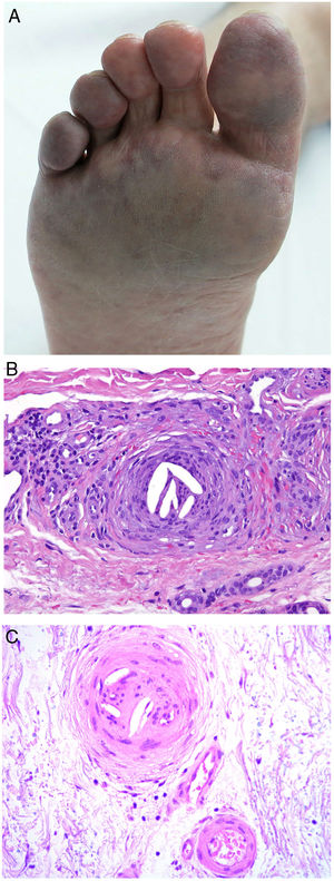 A, Livedo reticularis on the sole of the right foot of a patient with cholesterol crystal emboli. B, Cholesterol crystal emboli. Empty acicular spaces inside a blood vessel corresponding to cholesterol crystals that were dissolved during preparation of the biopsied tissue. A tissue response can be observed in the form of giant multinucleated cells surrounding the empty acicular spaces. Hematoxylin-eosin, magnification × 200. C, Late-phase emboli may show fibrosis surrounding the crystals and complete occlusion of the blood vessel. Hematoxylin-eosin, magnification × 200.