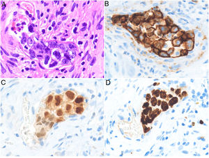 Intravascular large B-cell lymphoma. A, Capillary partially occluded by large blastic-appearing cells. Hematoxylin-eosin, magnification × 400. B–C, Immunohistochemical positivity for CD20 and MUM-1, respectively. Magnification × 400. D, Elevated Ki-67 antigen proliferation. Magnification × 400.