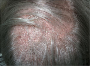 Alopecia plaque with diffuse scaling and underlying erythema.