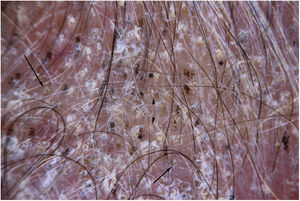 Dermoscopy showing comma hairs (arrow) and curly hairs (*) associated with broken hairs (arrow tip).