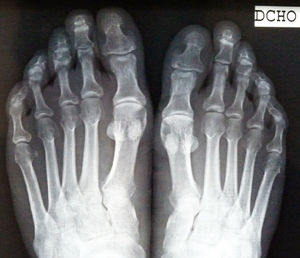 Simple anteroposterior x-ray with no abnormal bone findings.