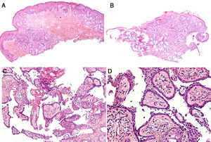 Histopathological features of the lesion. Hematoxylin-eosin, original magnification ×40 (A and C), ×100 (C), and ×200 (D).
