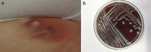 A, Abscess caused by S lugdunensis in the inguinal region of a patient receiving adalimumab treatment. B, S lugdunensis colony growing on blood agar.