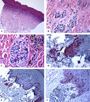 Immunohistological features of acral melanocytic nevus of the right big toe with (Melanocytic Acral Nevi with Intraepithelial Ascent of Cells, MANIAC): A-C: Sections show acral skin with a small well-circumscribed, symmetric compound melanocytic nevus. There is no confluence of nests. The nevomelanocytes lack any significant cytological atypia. Within the dermis, there are fibroplasia and few melanophages. D-E: Melan-A decorates the junctional and dermal nevomelanocytes. It shows a lentiginous pattern with the upward pagetoid migration of some nevomelanocytes (lacking cytological atypia) arranged as solitary units in the spinous layer (MANIAC). F: A patchy HMB45 staining is seen in the lentiginous nevomelanocytes along the dermoepidermal junction. HMB45 also stains occasional solitary nevomelanocytes in the lower reaches of the epidermis. Almost all of the dermal nevomelanocytes lack HMB45 protein expression, i.e immunohistochemical maturation. (Original magnifications: A: 20x, B: x200, C: x200, D: x 400, E: x200, and F: 400).