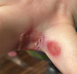 Progression to blisters and crusts.