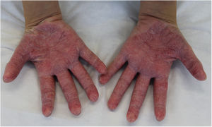 Erythematous scaly plaques on the palms.