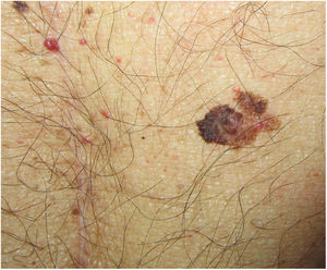 Melanoma diagnosed 4 months after a solid organ transplant, located just a few centimeters from the laparotomy scar, highlighting the importance of a full dermatologic examination before the procedure.