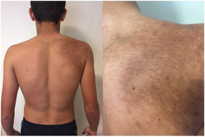 Hyperpigmented macule on the right scapular region and shoulder, present since birth. The comedones and hair on the macule appeared at puberty.
