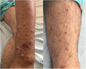 Clinical characteristics. On the upper extremities: skin-colored papules and nodules with an infiltrated appearance, some of which are ulcerated and others with a central crust. On the lower extremities: papules coalescing to form brownish-red plaques.