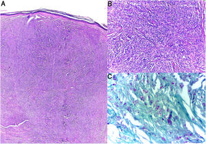Histopathology. A and B, Dermis with nodules formed by fusiform histiocytes in a storiform pattern (hematoxylin–eosin). C, Fite-Faraco staining. Multiple acid-fast and alcohol-fast bacilli.
