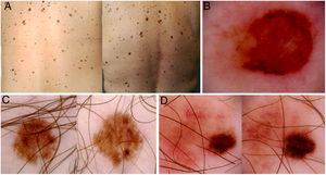 Images of total body maps and dermoscopy images of 3 patients enrolled in the study. A, Appearance of a palpable de novo pigmented lesion in the left lumbar region (circle). B, Dermoscopy of the lesion, showing structural asymmetry, polychromatic appearance, atypical reticulum, and central area with no structure. Histopathology showed a melanoma with a Breslow thickness of 1.4mm. C and D, In situ melanomas diagnosed due to dermoscopic changes in digital follow-up (asymmetric growth, focal changes in pigmentation, focal changes in structure).