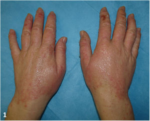 Scaly plaques and papules with well-defined borders on the dorsa of both hands.