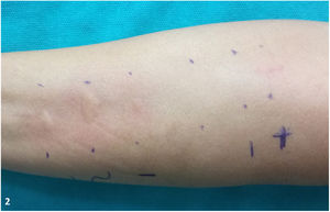 Positive prick test result to the patient’s own allergens: prawn, king prawn, and shrimp.
