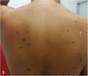 Patch test reading at 72 hours: uncertain positive result (+/−) to shrimp meat.