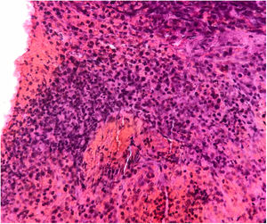 Basophilic small-cell tumor (100x).