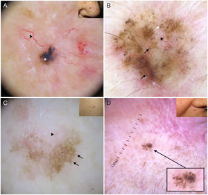 Dermoscopic structures in basal cell carcinoma (BCC). A, Infiltrative BCC; note the large blue-gray ovoid nest (white asterisk) and arborizing telangiectasias (triangle). B, Pigmented infiltrative BCC with multiple blue-gray globules (black arrows), blue-gray dots (white arrow), and arborizing telangiectasias (triangle). C, Pigmented superficial BCC with fine telangiectasias (triangle) and maple leaf–like areas (black arrows). D, Pigmented 2-mm BCC with multiple concentric structures.