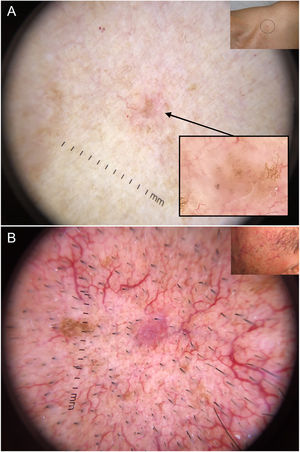 Very small basal cell carcinomas (BCCs). A, 2-mm micronodular BCC, detected by the presence of pigmented structures (multiple blue-gray dots); note the interruption of the surrounding skin structures (telangiectasias and lentigines). B, 3-mm nodular BCC with fine telangiectasias and hairpin vessels.