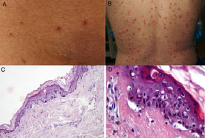 A and B, Patients with coronavirus disease 19 (COVID-19) with a papulovesicular rash on the trunk. Note the vesicles with a central varicella-like crust in the photograph on the left (A). C and D, Histopathologic changes in patients with COVID-19 and a varicella-like rash. C, Slightly atrophic epidermis, basket-weave hyperkeratosis, vacuolar degeneration of the basal layer with multinucleated, dyskeratotic hyperchromatic keratinocytes (hematoxylin-eosin, original magnification ×10). D, At higher magnification (hematoxylin-eosin, original magnification ×40), note the vacuolar alteration with disorganized keratinocytes with altered maturation and multinucleated keratinocytes with dyskeratotic cells.