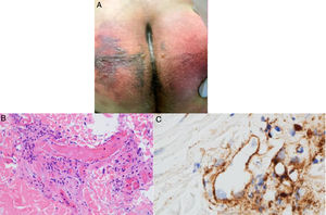 A, 32-year-old man with coronavirus disease 2019 who developed retiform purpura on his buttocks 4 days after initiation of mechanical ventilation due to acute respiratory failure. B, Skin biopsy showing extensive pauci-inflammatory vascular thrombosis with endothelial cell injury (hematoxylin-eosin, original magnification ×40). C, C5b-9 deposits in microvessels (diaminobenzidine, original magnification ×40).