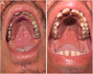 A, Infiltrative plaque on the mucous membrane of the soft palate. B, Clinical appearance after 2 weeks of multidrug therapy with the World Health Organization recommended regimen (rifampicin, clofazimine, dapsone).