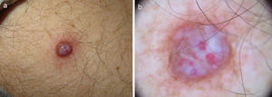 A, Firm erythematous-violaceous, papulonodular lesion on the external aspect of the left arm. B, Dermoscopic image showing whitish structures on an erythematous base, nonarborizing telangiectasias, vessels with a glomerular appearance, and a slight brown reticular pattern mainly on the periphery.