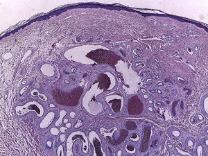 Well-circumscribed vascular proliferation in the dermis, with vessels covered with a single layer of endothelial cells. Some vessels have a thick fibromuscular wall, with no definitive presence of elastic lamina, whereas others have a thinner wall (hematoxylin-eosin, ×40).