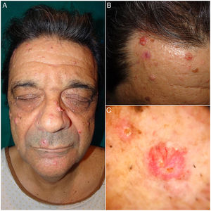 A and B, Clinical images of sebaceous adenoma. Multiple pink tumors on the face measuring 5 to 25mm. C, Dermoscopic image of sebaceous adenoma. Note the pale yellowish globules over an erythematous base, together with branching tortuous vessels.