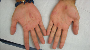 Palmar lesions.