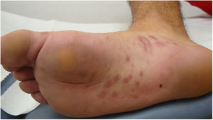 Plantar lesions.
